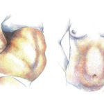 diastasis