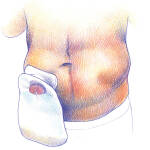 bolsa colostomía