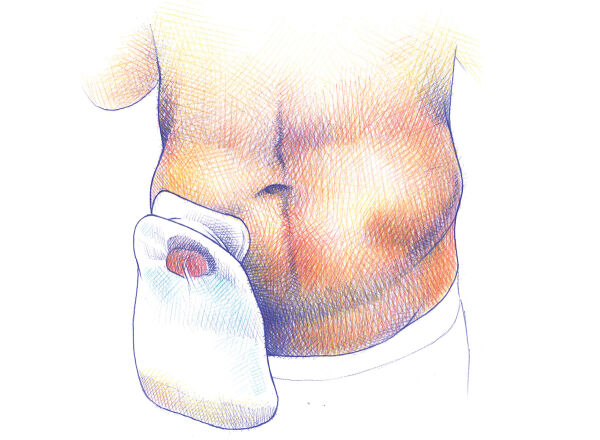 bolsa colostomía